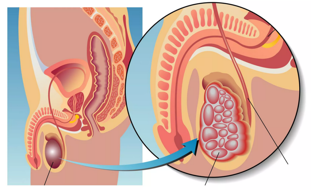 Un testicule plus gros que l'autre