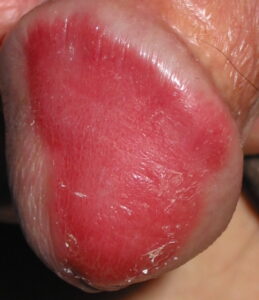 rougeur sur votre verge